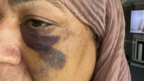PA Media A close up photo of a woman's face. She has a dark bruise unde her eye and wears  pale pink headscarf 