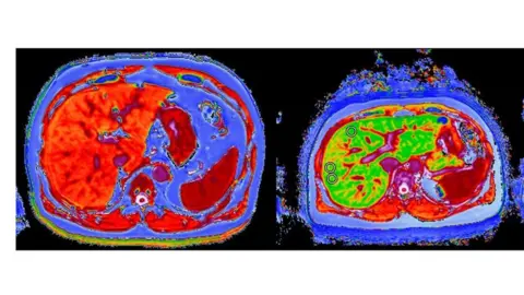 Perspectum Diagnostics liver scans