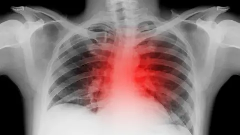 Getty Images Chest x-ray