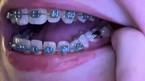 A child's mouth is open showing fixed braces showing a section of missing wires