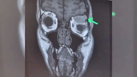 Supplied An MRI scan of Stephen Lewis' head showing a tumour between the eye and brain.