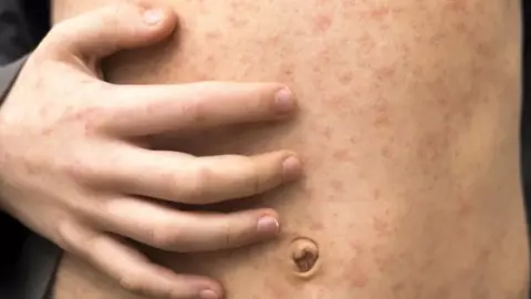 Getty A person with measles
