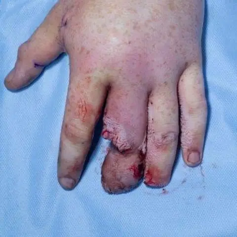 BAPRAS A hand damaged by fireworks