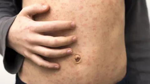 Getty Images Stock photo of a child with a measles rash