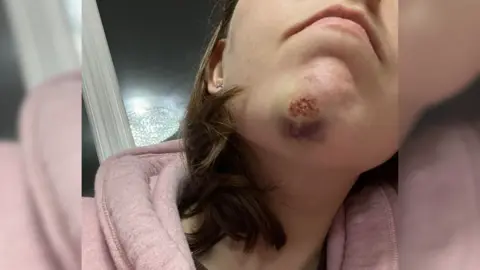 Supplied Emma sporting her injured chin