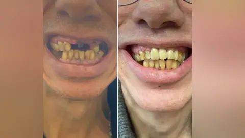 Homeless Street Angels John Nicholson's teeth before and after treatment