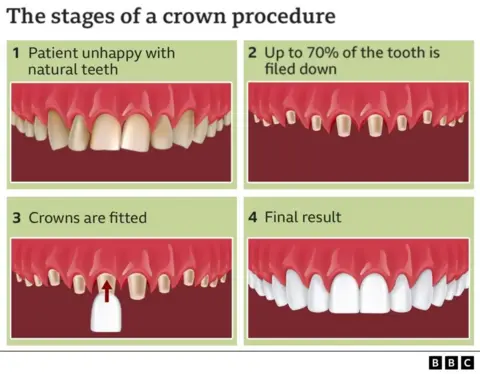 A diagram with four pictures showing the process of making a dental crown, as the teeth are placed on the bottom and the crowns are placed on top. It states: 1) Patient unhappy with natural teeth; 2 Up to 70% of the tooth is placed on the floor; 3) The crown is placed; 4) The final result. The last photo shows a row of bright, bright white teeth.