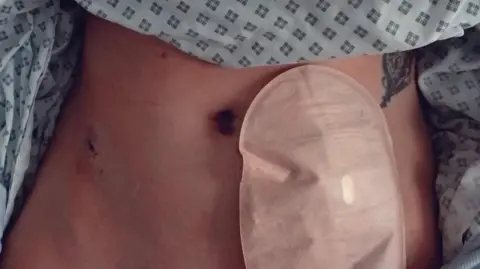 Emma Williams-Tully Emma's stomach, with her stoma bag and surgery scarring