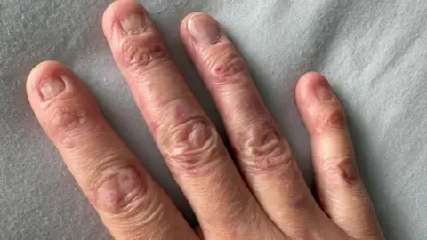 PA Media An image of Jennifer's hands which are blistered and scarred from where her skin has been constantly damaged. She only has a complete nail on her ring finger.