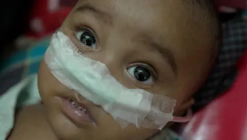BBC Close-up of a young Bangladeshi child lying down with a feeding tube secured across his nose with white medical tape