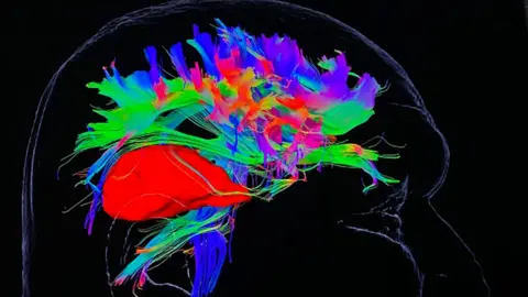 An image of the Elements software showing a the side view of a head with a series of bright colours highlighting different parts of the brain