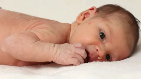 Getty Images Baby with eczema