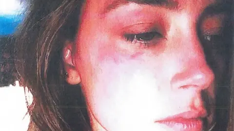 Reuters Amber Heard's bruises