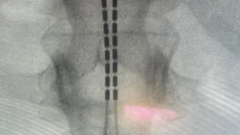 Professor Kirk Levins A close-up x-ray image of what looks like a spine with two black wires running through it.