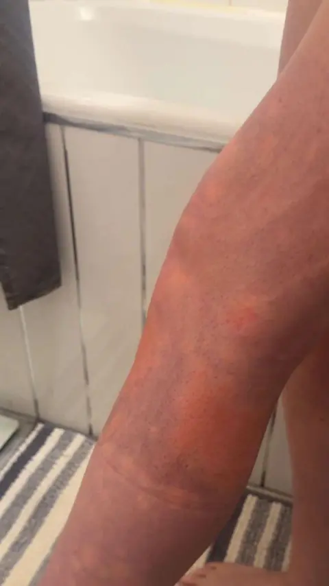 Jessica Gatherer Jessica Gatherer's leg. It is discoloured.