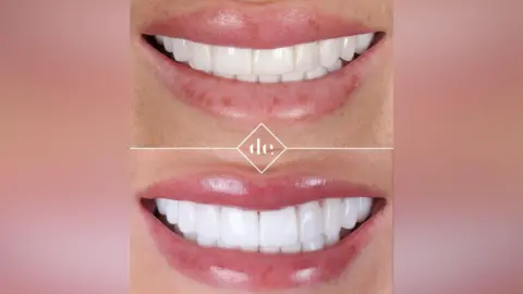 Dr Robbie Hughes Two photographs showing a close up of Jade's mouth. The top image shows the misaligned veneers and the second photograph shows the correctly aligned replacement veneers.