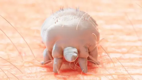 Getty Images A stock illustration of Sarcoptes scabiei, the tiny mite which causes scabies