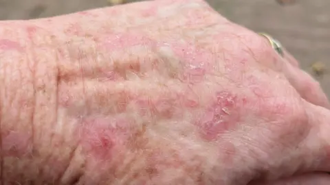Contributed A view of Mrs Smart's hand which is covered in red sores and peeling skin.