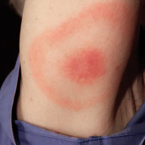 Science Photo Library A tick bite rash