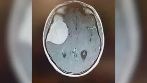 Holly Worswick An MRI scan showing a black and white image of a brain with a brain tumour on the left side of the brain. 