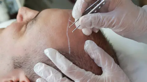 Getty Images Hair transplant