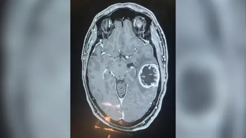 Charles Trigg An x-ray of a brain tumour