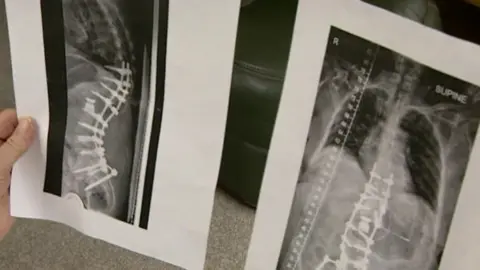 Judith Mills nga nagkupot ug X-ray sa iyang dugokan