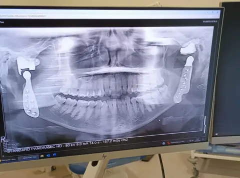 PA Media An x-ray image on a computer screen showing Toni Bull's skull with two titanium joins implanted
