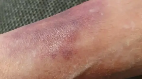 Peter Clarke A zoomed in photo of Ms Clarke's arm. You can see there is pinkish-red bruising.