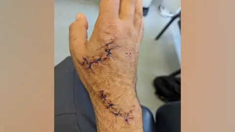 Gualberto Ramirez  Gualberto Ramirez' hand with stitches after dog attack