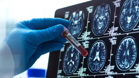 Getty Images A humor sample being checked against a encephalon scan