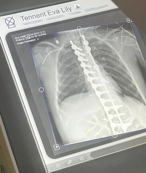 Jill Lockhart A chest x-ray shows Eva's spine after her surgery
