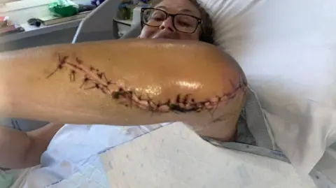 Suzie Dyer A woman is lying in a hospital bed - she is wearing glasses and holding up her elbow.  A huge, stitched up scar can be seen from the end of her elbow to half way along her arm.