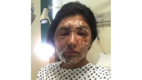 Resham Khan Resham Khan with facial burns