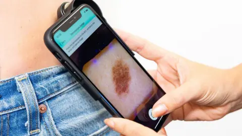 Skin Analytics A phone with an app to analyse moles and lesions for skin cancer is being used on a person. The phone is being held by a hand. It is being held against a person's skin. A mole is visible on the phone screen. The person is wearing jeans. 