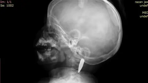 FDCO / UK-Med A CT scan showing a bullet in the back of the girl's neck