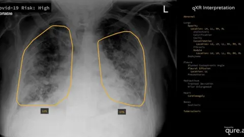 Qure.ai Lung x-ray examined by Qure.ai