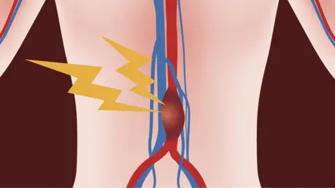 Getty Images Graphic of aortic aneurysm