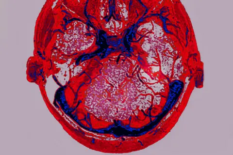 Alamy Cerebral venous thrombosis - CTA scan