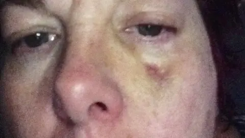 Sharon Morris's bruise on cheek