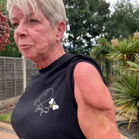 A woman turned side on to the camera with the sleeve of her t-shirt rolled up to expose her upper arm, which has a large scar. She has short blonde hair and it wearing a black t-shirt with a logo that says 'bee free' with a picture of a bee. She is outside and there are plants, trees and a fence in the background.