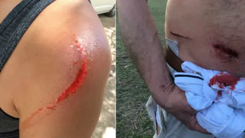 Shane Lewis Wounds from a kangaroo