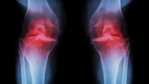 Getty Images An x-ray of a pair of knees. There are red areas in the knee joints that stand out from the white bones.