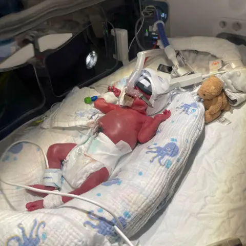 Laura Pridding George when he was first born, he is very pink and there are a lot of tubes attached to him. He also has an oxygen tube attached to him. There is a brown teddy next to him. 