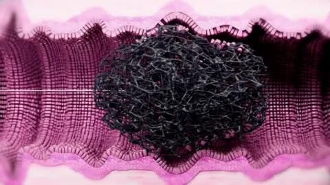 CYTED A computer generated image of a sponge with a thread attached to it being pulled up an oesophagus. Pink coloured cells can be seen dislodging from the oesophagus walls and attaching to the sponge.