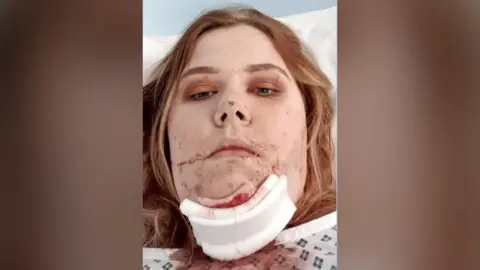A 2019 photo of Jade lying in a hospital bed shortly after her accident. She has long, light brown hair and are wearing a white medical neck brace that extends from the lower face to the upper chest. There is visible redness or blood around the lips and chin area, suggesting recent trauma or injury. She is resting on white bedding, and the background features a light blue wall, contributing to the clinical setting.
