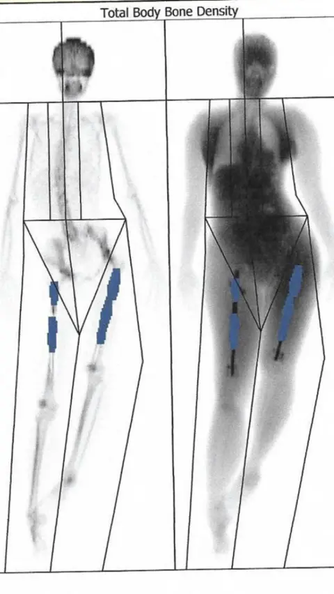 Elaine Foo/Supplied A scan showing Elaine's lengthened right leg beside her unlengthened left leg.