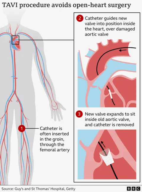 Graphic illustrating how the TAVI procedure works by inserting a new valve via a catheter through a blood vessel.