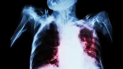 Thinkstock Tuberculosis lungs x-ray - mocked up by Thinkstock