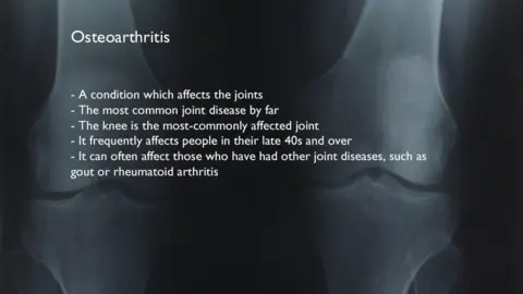 Thinkstock An x-ray of two knees with some facts about osteoarthritis